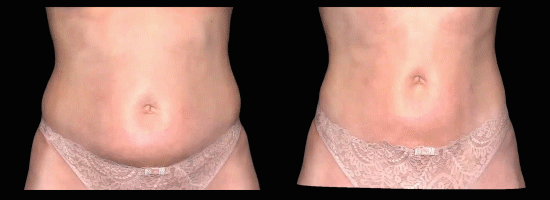 body sculpting skin tightening ultrasonic cavitation treatment