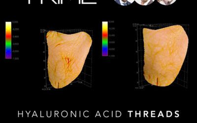 LifeViz® Mini used in study on Hyaluronic Acid threads for skin improvement