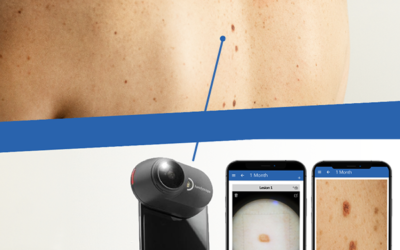 QuantifiCare Partners with FotoFinder to Bring Mobile Dermoscopy to Clinical Trials